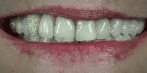 Snap-On Veneers for Upper and Lower Teeth with Removable Smile Cover