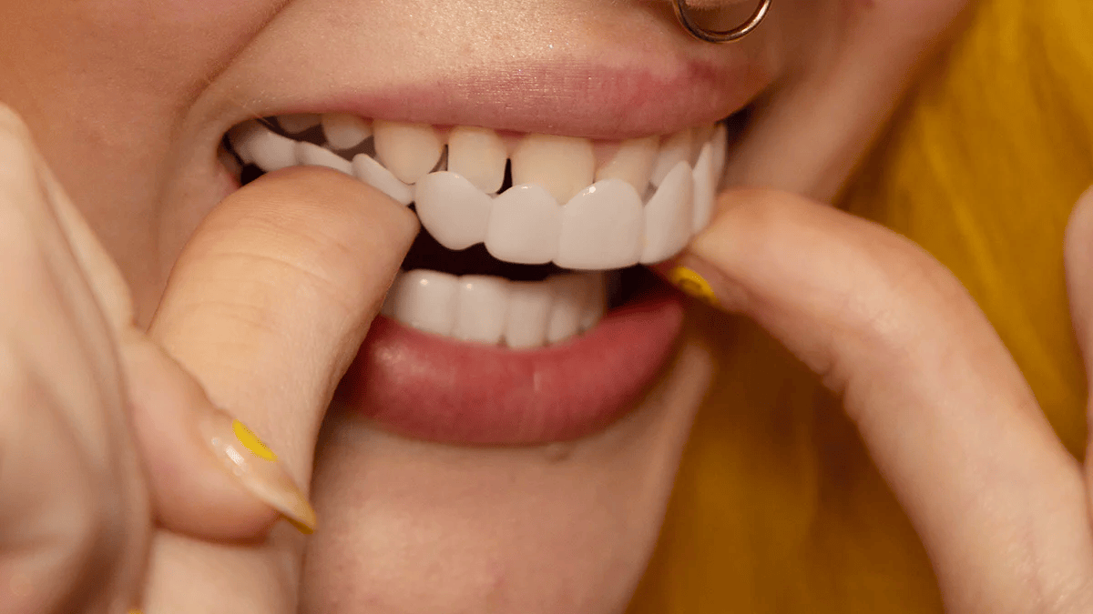 Snap-On Veneers for Upper and Lower Teeth with Removable Smile Cover