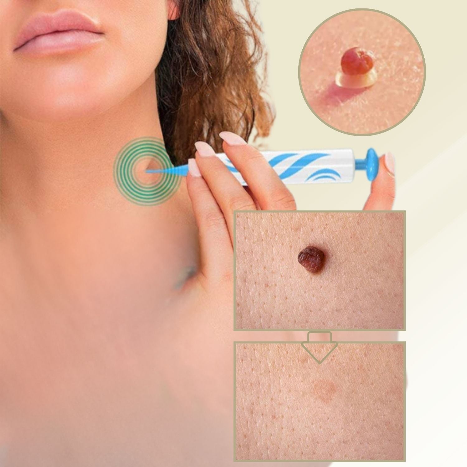 Pain Free At Home Wart and Mole Remover Skin Care Treatment