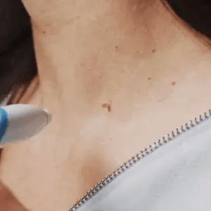 Painless Skin Tag Remover Kit | At-Home Targeted Removal Tool