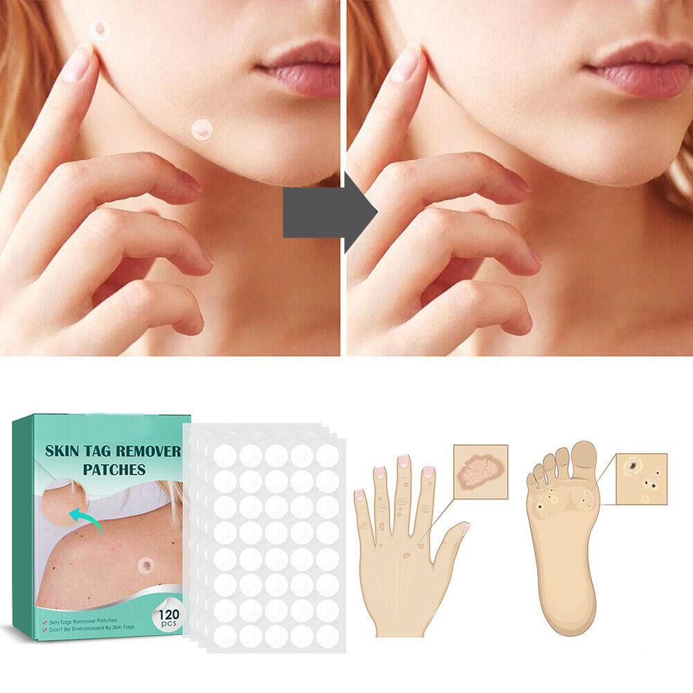 Discreet Skin Clearing Patch for the Removal of Spots and Warts