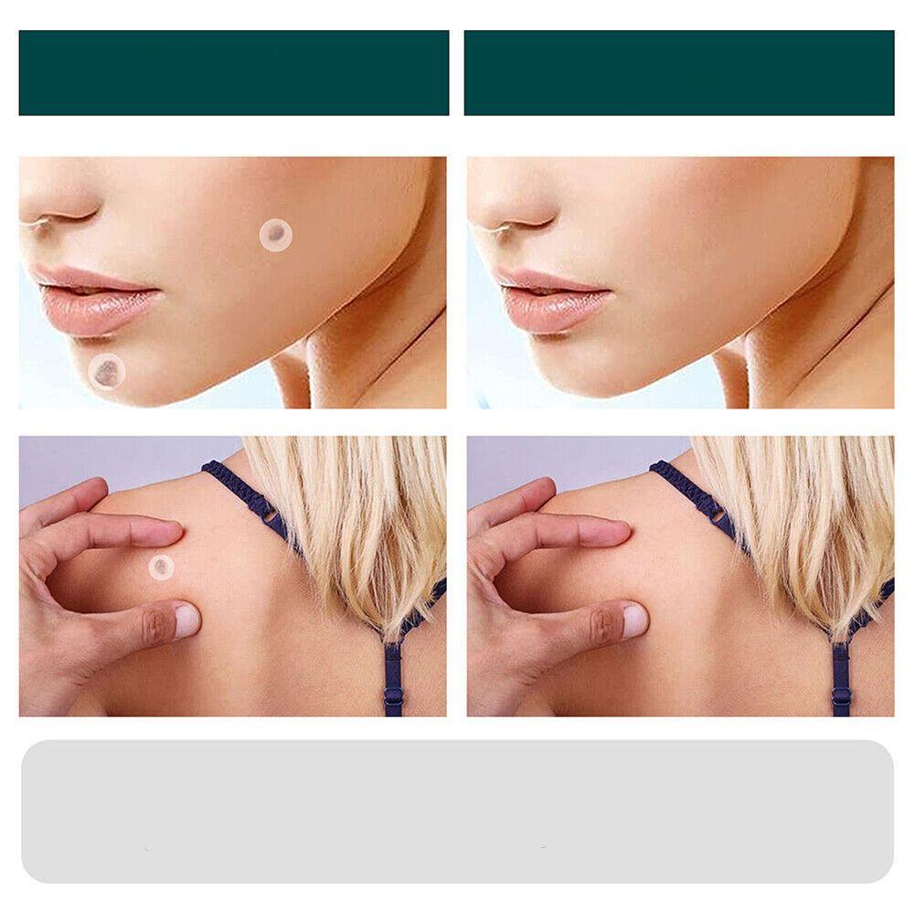 Spot and Wart Removal Patches for Skin Care Kalsten Treatment