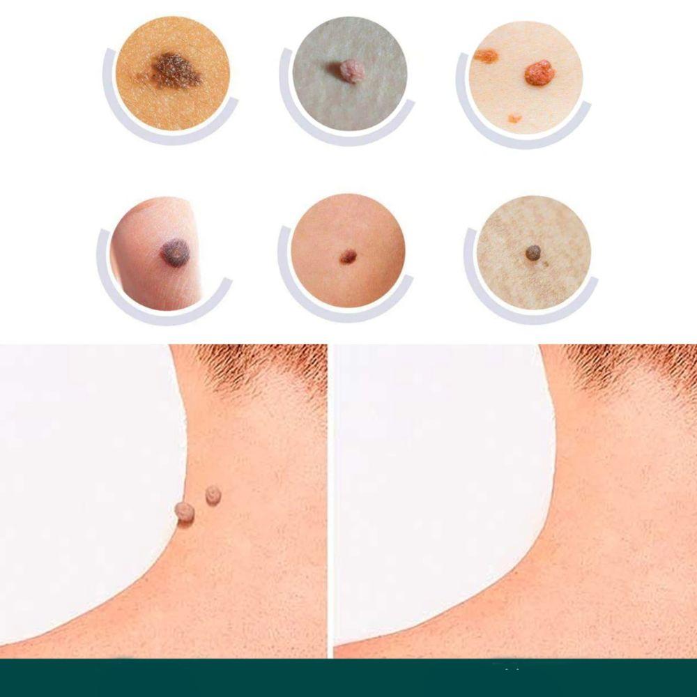 Spot and Wart Removal Patches for Skin Care Kalsten Treatment