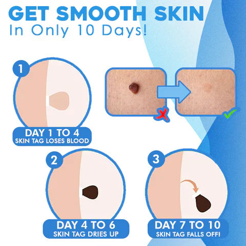 Painless Skin Tag Remover Kit | At-Home Targeted Removal Tool