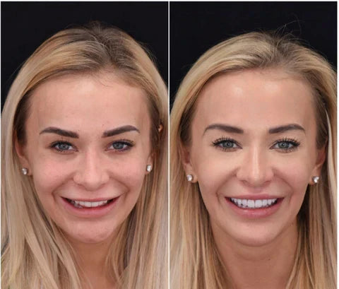 Snap-On Veneers for Upper and Lower Teeth with Removable Smile Cover