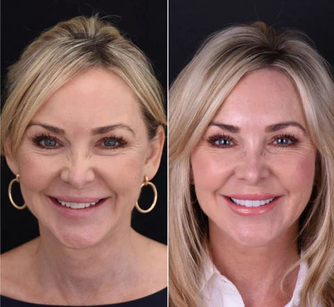 Snap-On Veneers for Upper and Lower Teeth with Removable Smile Cover
