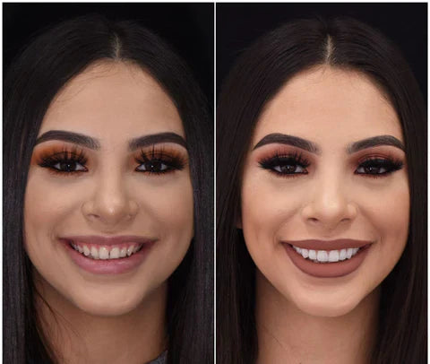Snap-On Veneers for Upper and Lower Teeth with Removable Smile Cover