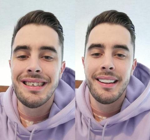 Snap-On Veneers for Upper and Lower Teeth with Removable Smile Cover
